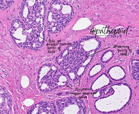 Case 3 Pelger Huet Vs Pseudo Pelger Huet Neutrophils Infographic