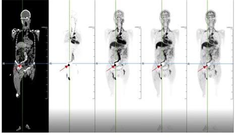 Table From Advantages And Applications Of Total Body Pet Scanning