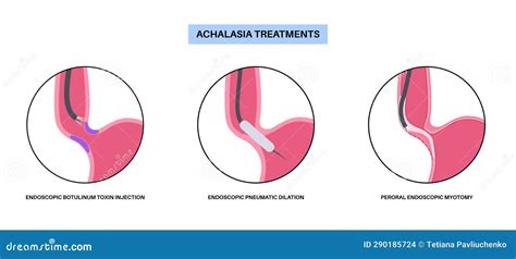 Esophageal Achalasia Wikipedia