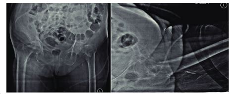 Preoperative Ap And Lateral Radiographs Download Scientific Diagram