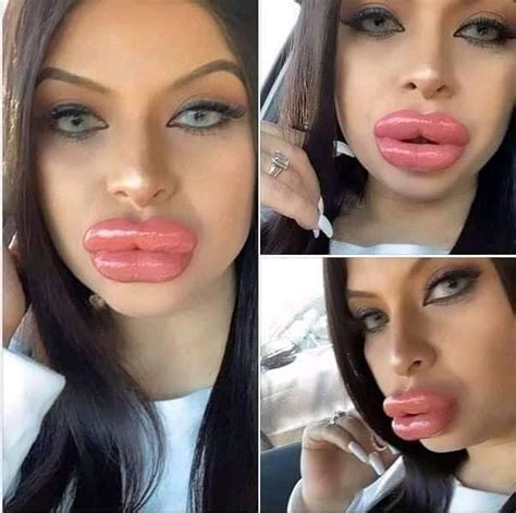 Botched Surgeries That Went Horribly Wrong Plastic Surgery Bad