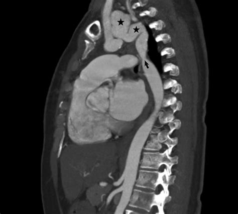 Enhanced‐contrast Computed Tomography Revealed Coarctation Of Download Scientific Diagram