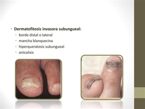 Dermatofitosis O Tiñas Ppt Descarga Gratuita