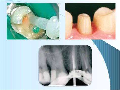6restoration Of The Endodontically Treated Tooth