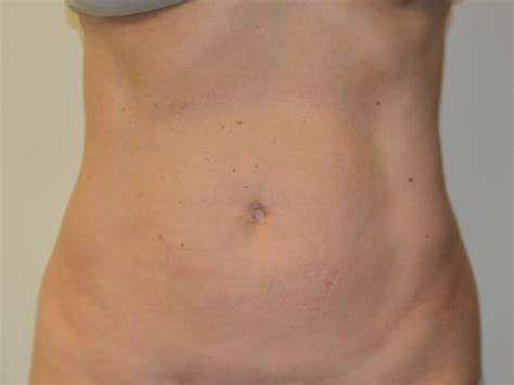 Liposuction Before After Gallery Allen Doezie Md Facs