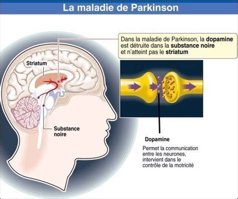 Maladie De Parkinson