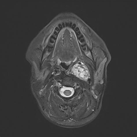 Sympathetic paraganglioma | Radiology Case | Radiopaedia.org ...