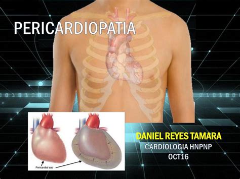 Pericardiopat A Ahmed Casana Udocz