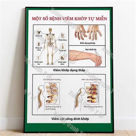 Mua Tranh Khung Tranh Xương Khớp Một Số Bệnh Viêm Khớp Tự Miễn