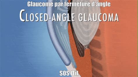 Glaucome Aigu Glaucome Par Fermeture D Angle Angle Troit