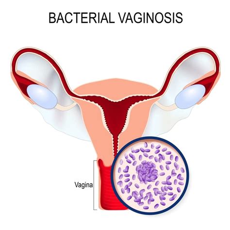 Bacterial Vaginosis Needs New Treatment Approaches Monash Lens