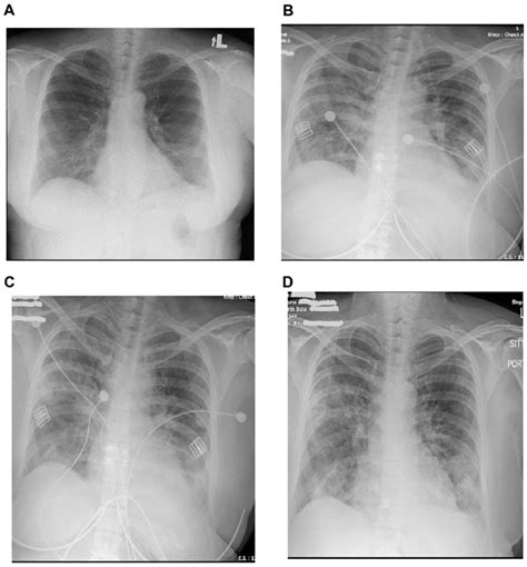 Chest X Ray Findings During Hospitalization Course A Day 1 Download Scientific Diagram