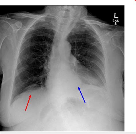 Chest Radiography Remarkable For A Moderate Size Hiatal Hernia Blue Download Scientific