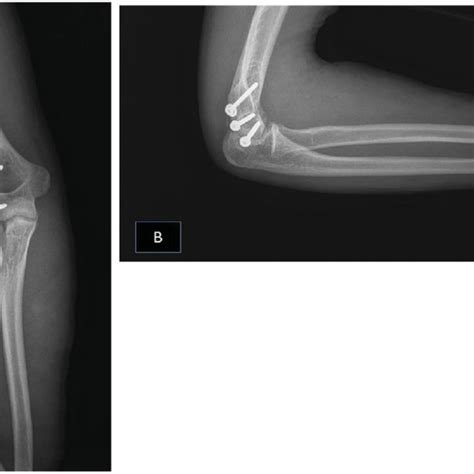 Post Operative Ap A And Lateral B Radiographs Of The Patient