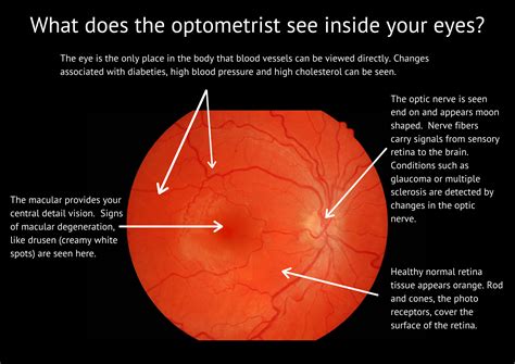 Mcdonald Adams Optometrists Things We Can See In Your Eyes