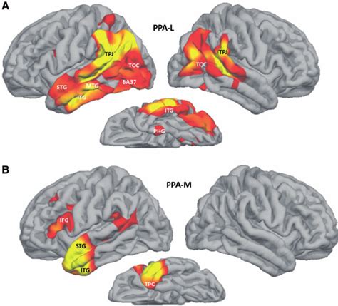 Atrophy Patterns In Ppa L And Ppa M Red And Yellow Areas Designate