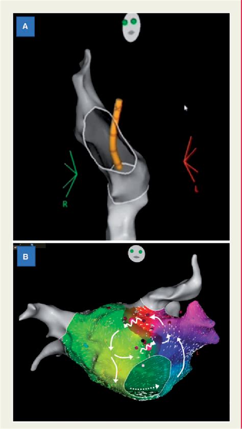 Figure From Zero Fluoroscopy Trans Septal Puncture And Catheter