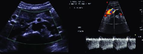 2 Transvaginal Color Doppler Ultrasonography In A Patient With Gonadal