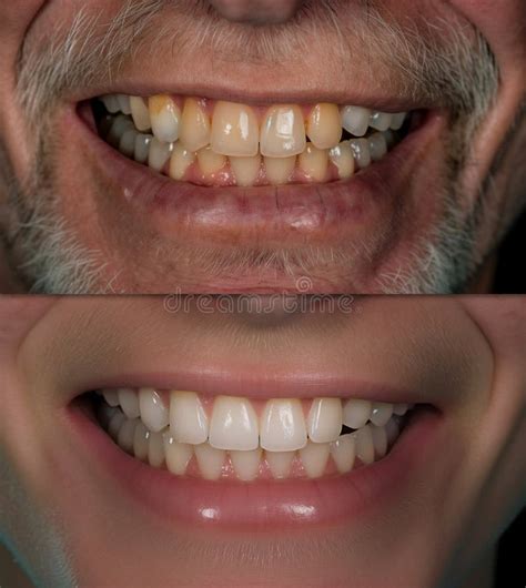 Hombre Barbudo Muestra Su Hermoso Trabajo Dental Antes Y Despu S De Los