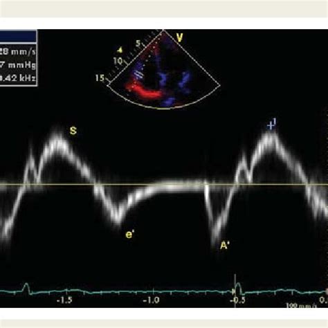 Pdf Functional Capacity And Right Ventricular Function In Patients