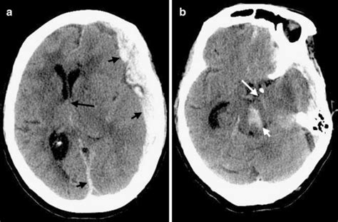 Duret hemorrhage with cerebral herniation. Large left holohemispheric ...