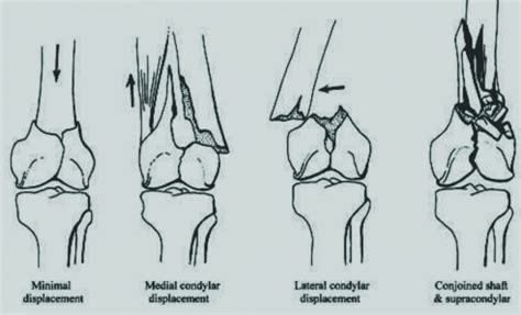 Distal Femur Fracture Classification Periarticular Fractures Of The | Sexiz Pix