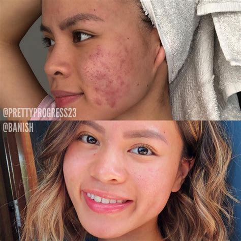 How To Get Rid Of Pitted Acne Scars