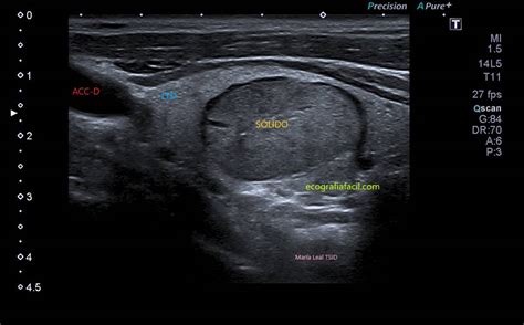 208 Clasificación Ti Rads Nódulos Tiroideos Ecografía Fácil