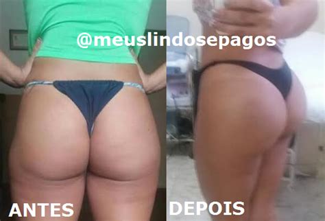 Meus Lindos E Pagos Arquivos Gluteoplastia Ml Silimed