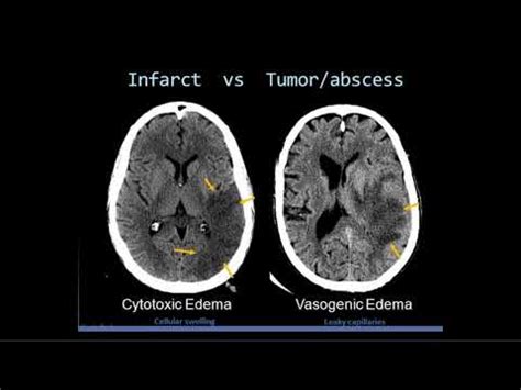 Intro To Head CT Part II Evaluation Of Ischemic Stroke YouTube