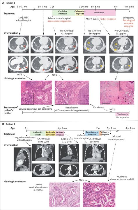 Lung Cancer Screening Nejm