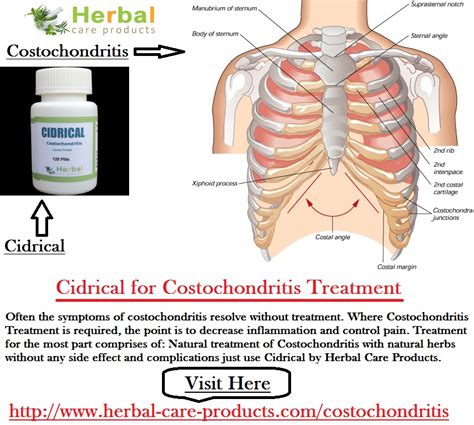 Natural Herbal Remedies for Costochondritis - Herbal Care Products