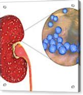 Acute Pyelonephritis Caused By Enterococcus Photograph By Kateryna Kon