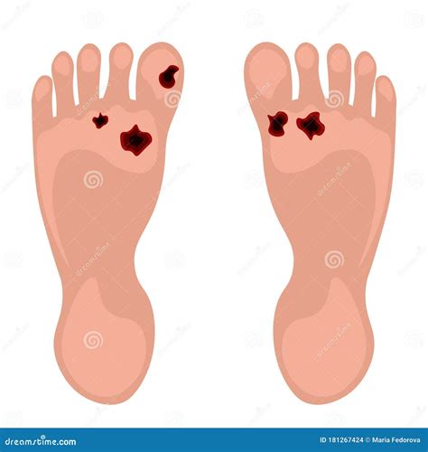 Diabetic Foot Medical Vector Illustration Scheme