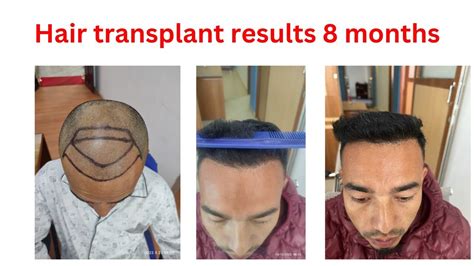 Hair Transplant Results After 8 Months In Nepal । Best Hair Transplant