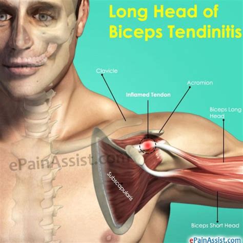 Long Head Of Biceps Tendinitis LowerBackPain Bicep Tendonitis Bicep