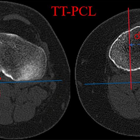 Tt Pcl The Tt Pcl Distance Was Determined As The Mediolateral Distance