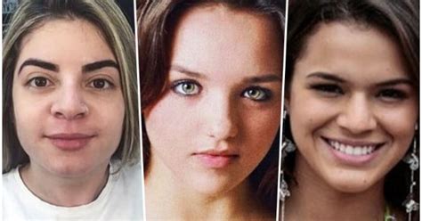 Confira O Antes E Depois Das Cirurgias Plásticas De 15 Famosas