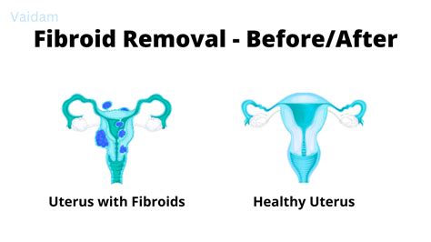 Laparoscopic Myomectomy For Fibroids Cost In Mediclinic Cape Gate