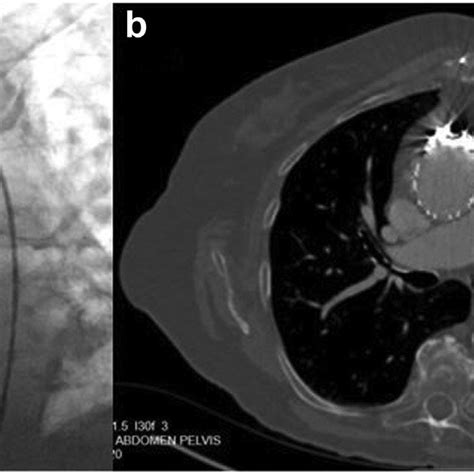 Angiogram Showing Patent Viabahn Chimney Stent Graft In Free Vein