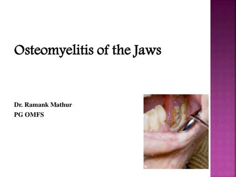 Osteomyelitis Of Jaws