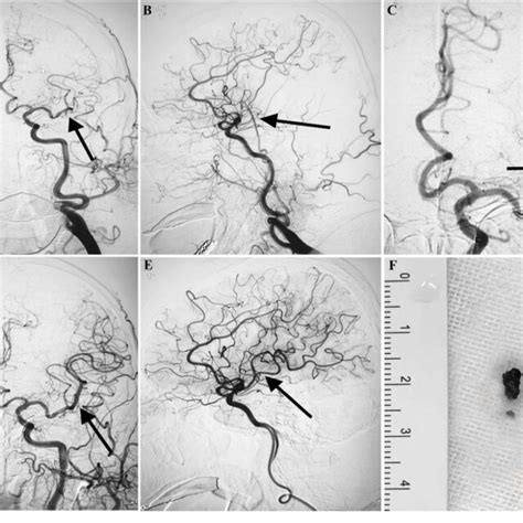 Mechanical Thrombectomy Procedures A DSA Reveals Persistent L MCA M2