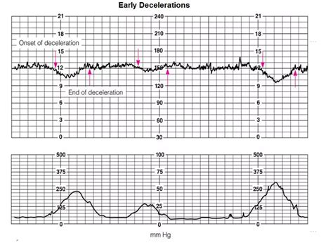 Antepartum Fetal Assessment Ppt