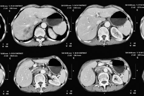 Durvalumab Immunotherapy Recommended For Advanced Bile Duct Cancers In