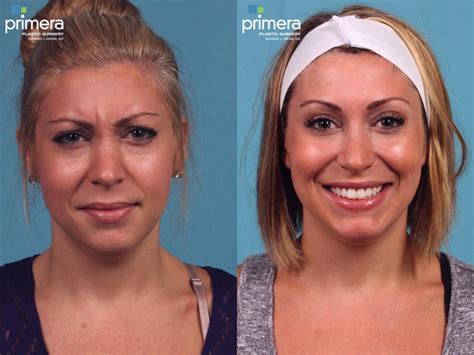 BOTOX Cosmetic Before And After Pictures Case 388 Orlando Winter