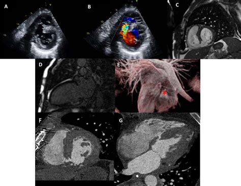 A Transthoracic Echocardiogram Of Basal Short Axis View Showing