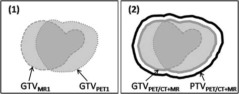 Simultaneous 68Ga DOTATOC PET MRI For IMRT Treatment Planning For