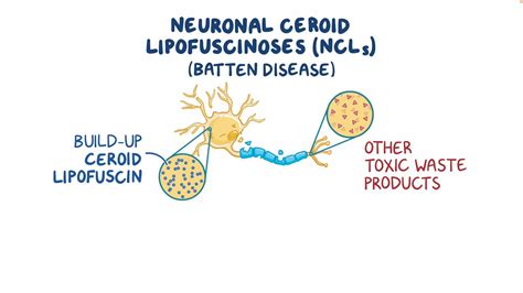 Neuronal Ceroid Lipofuscinoses Batten Disease Year Of The Zebra