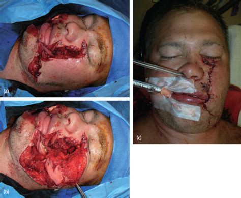 Facial Injuries Photos Telegraph