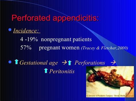 Appendicitis During Pregnancy